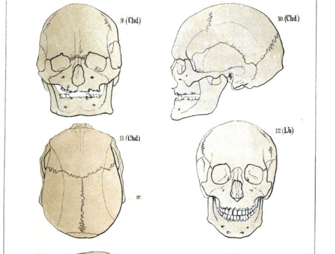 The Inspection of Albanian skulls in 1877 by&nbsp;Virchow
